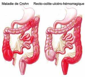la maladie de Crohn et la colite ulcéreuse
