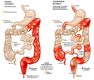 la Enfermedad de Crohn y la colitis ulcerosa