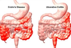 Crohn's disease and ulcerative colitis